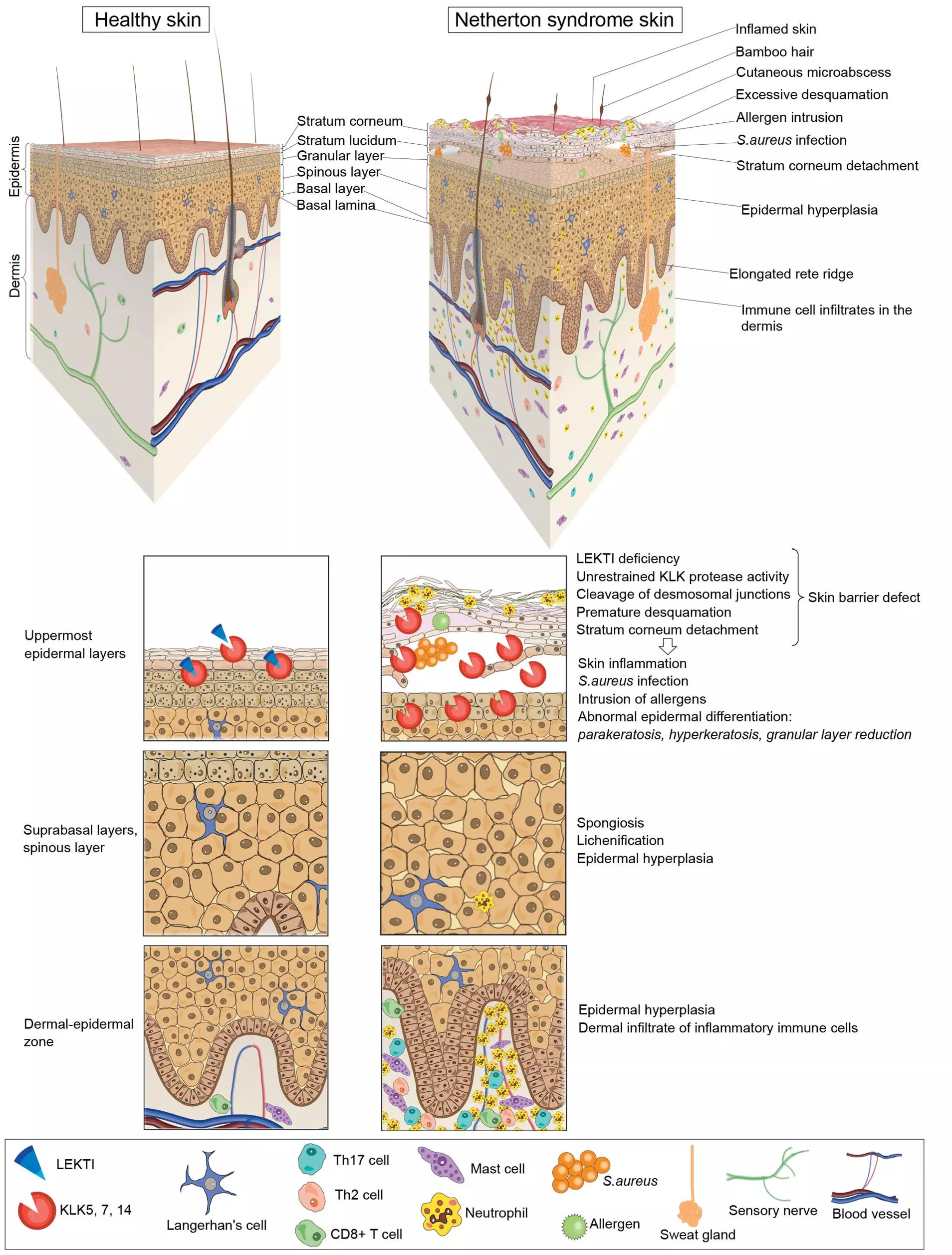 Cellular and histopathological hallmarks of NS patient skin