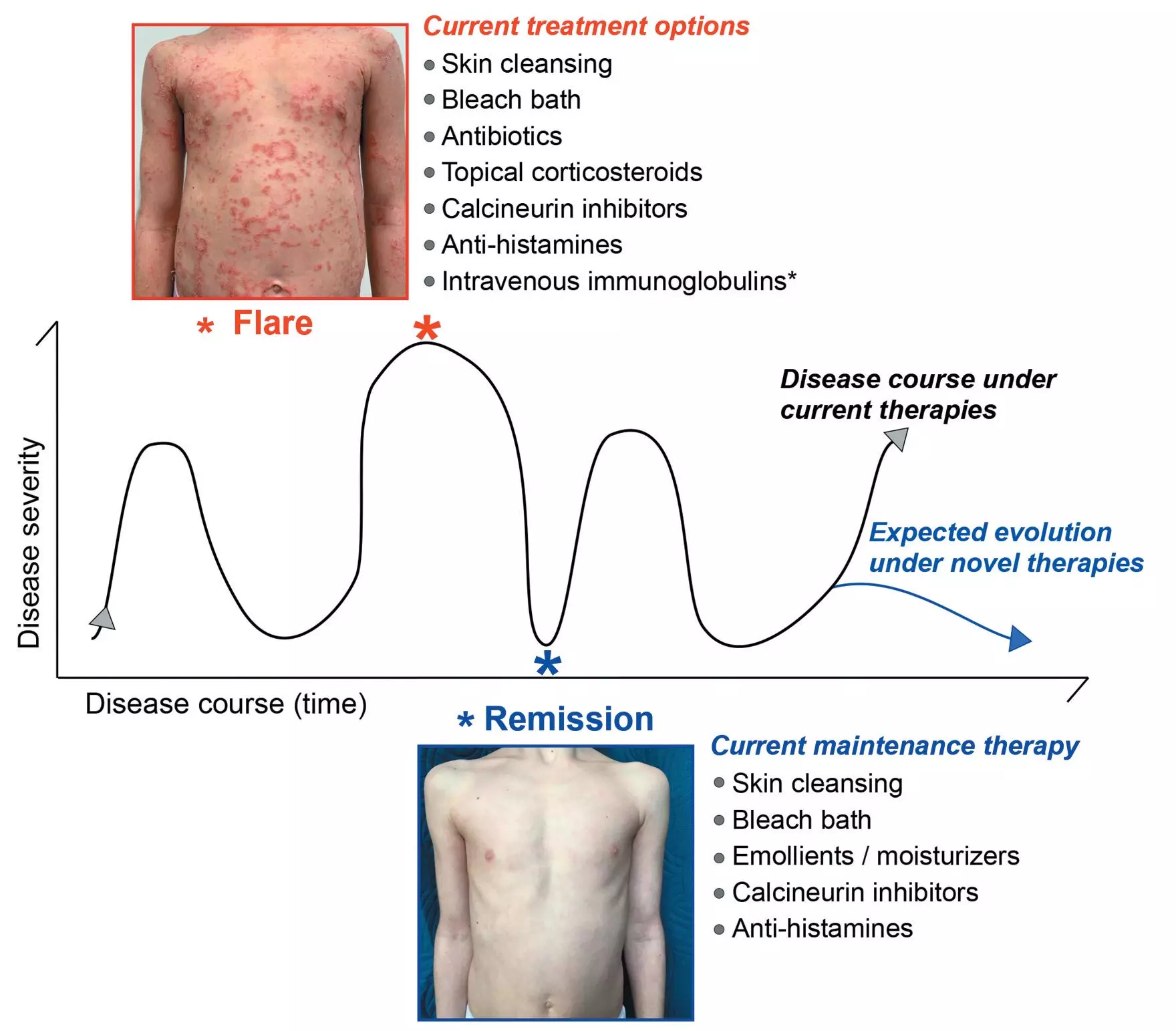 Common therapeutic approaches to breaking the vicious cycle of epidermal barrier defects and inflammation in Netherton syndrome
