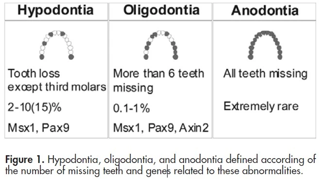 Hypodontia oligodontia and anodontia defined according of the number of missing teeth