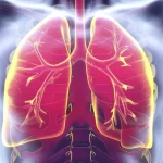 Silicosis | Causes, Diagnosis, and Prevention
