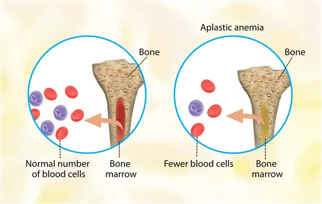 Aplastic Anemia | Causes, Symptoms, Diagnosis and Treatments