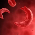 Sickle Cell Anemia | Causes, Symptoms, Diagnosis and Treatments