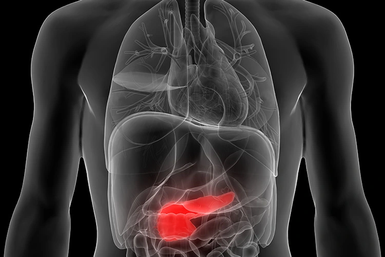Acute Pancreatitis | Causes, Symptoms, Diagnosis and Treatments
