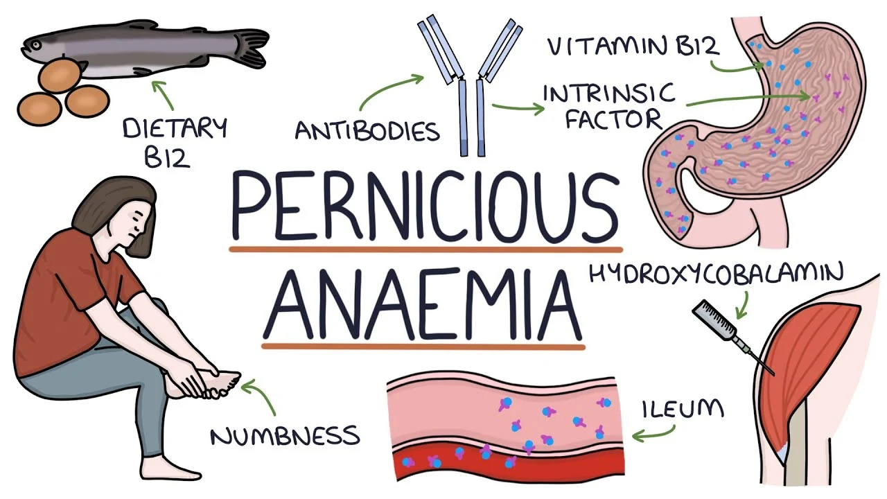 Pernicious Anemia | Causes, Symptoms, Diagnosis and Treatments