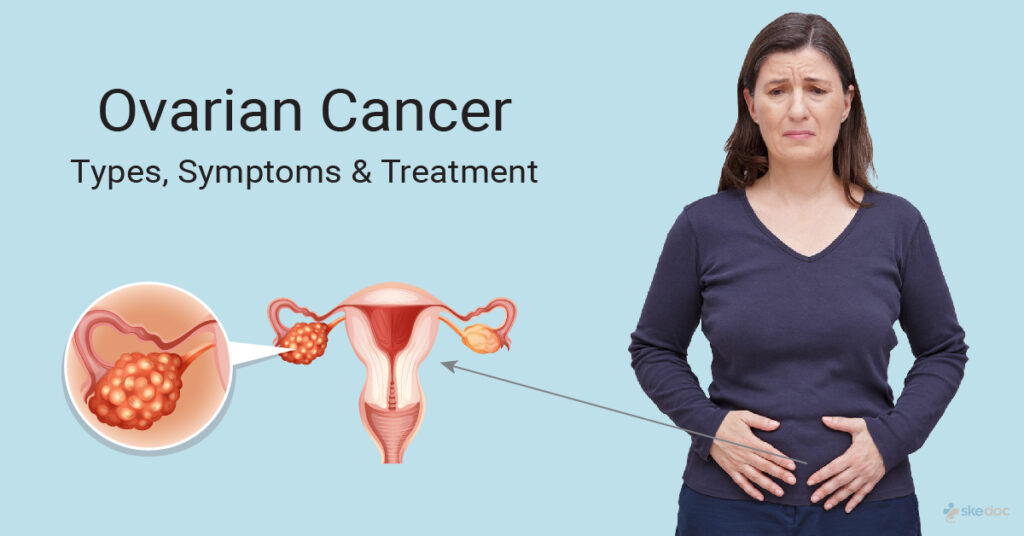 How to Check for Ovarian Cancer at Home