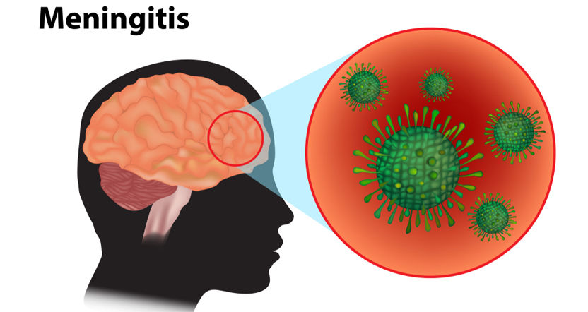 Early-Stage Meningitis Symptoms