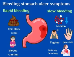 bleeding stomach ulcer symptms including anemia, bloody voitiming and dark bloody stool.