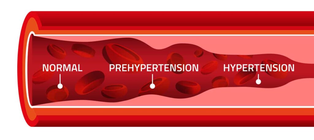 Complications of Hypertension