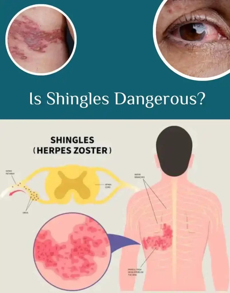 Is shingles contagious by touch or airborne? several critical issues after infection with shingles