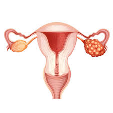 Ovarian Cancer Risk Factors