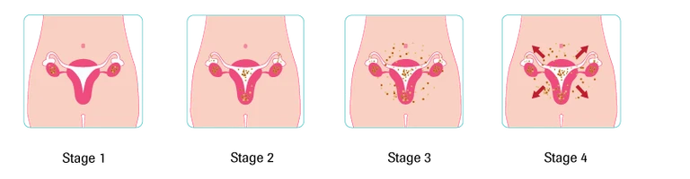 Stage 2 Ovarian Cancer Symptoms