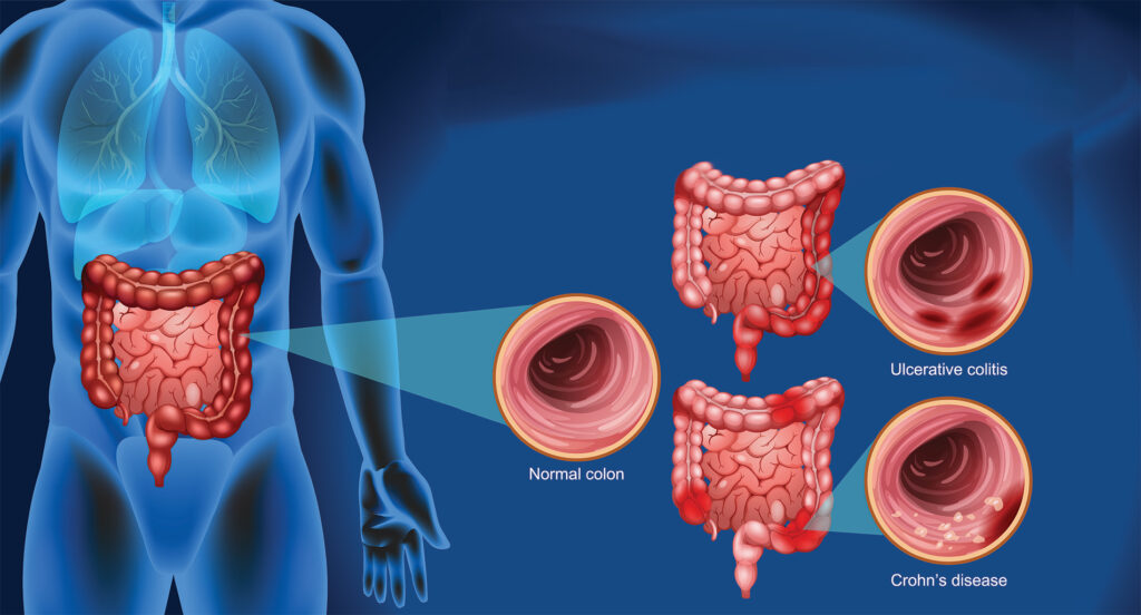 Symptoms of Crohn’s Disease in Females