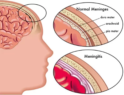 Symptoms of Early-Stage Meningitis and Vaccines for it