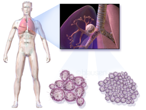 Symptoms of Lung Cancer in males