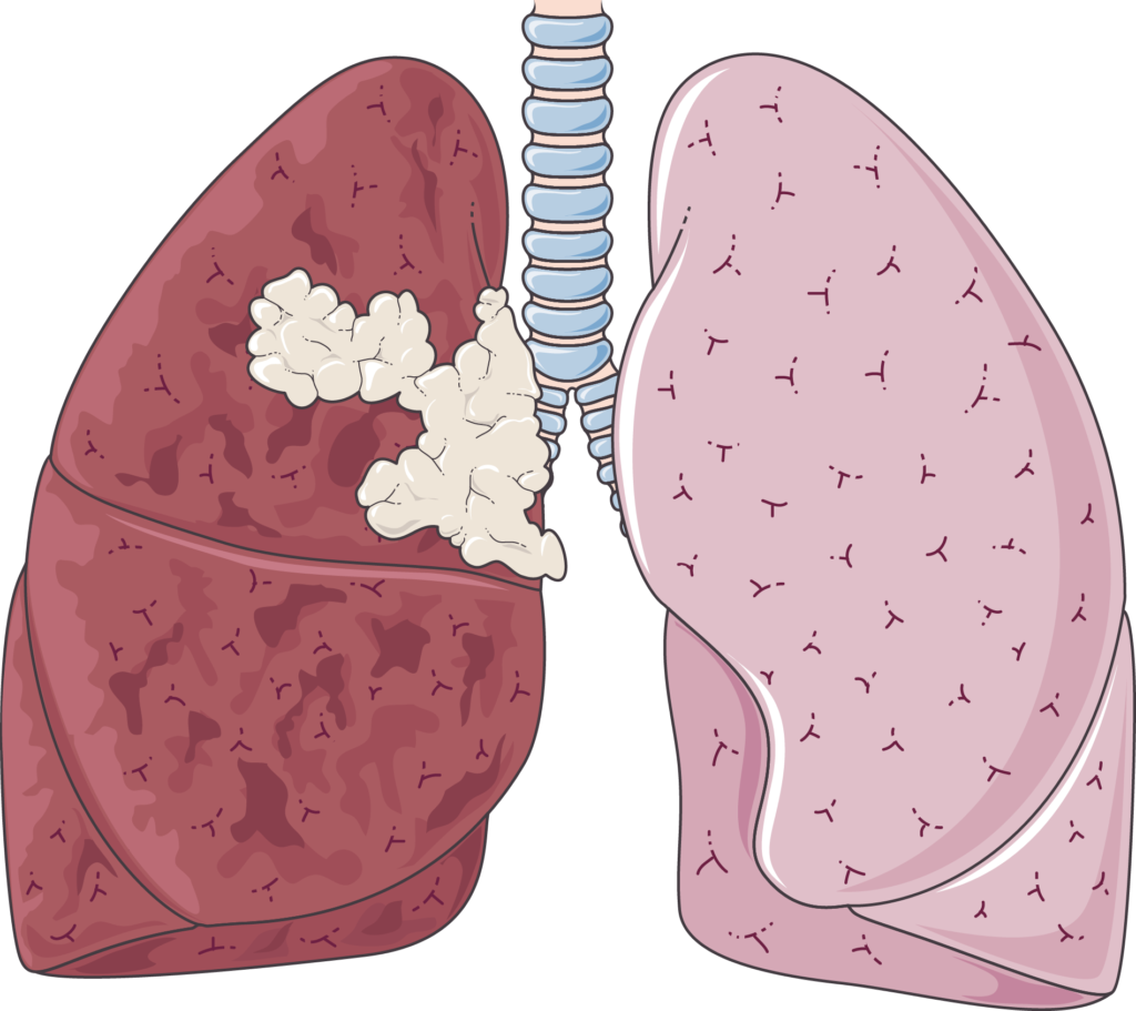 stage 4 lung cancer survival rate by age